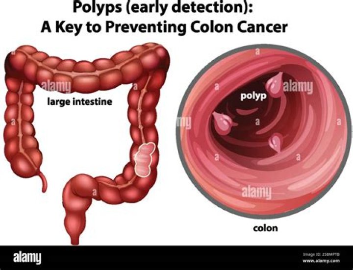 Are polyps in the stomach common?