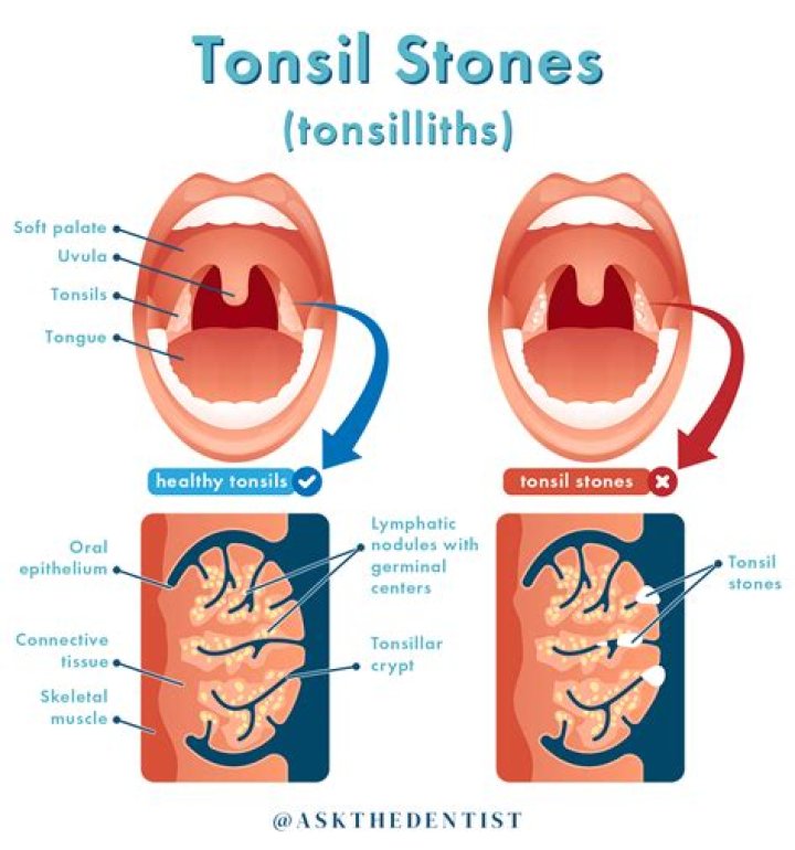 Are tonsil stones crumbly?