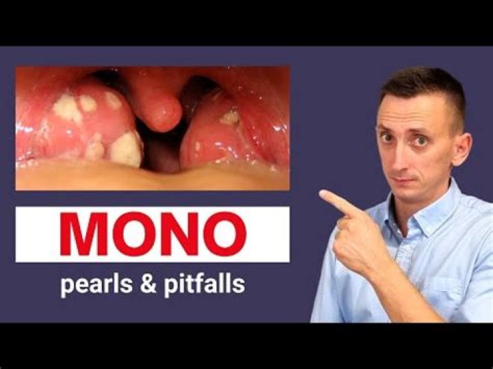 Are tonsils white with mono?