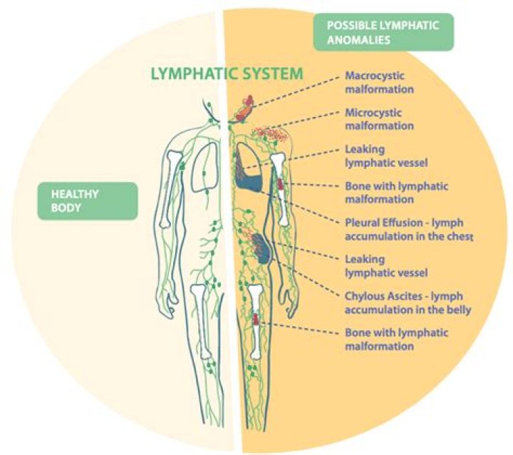 Can a clogged lymphatic system cause weight gain?
