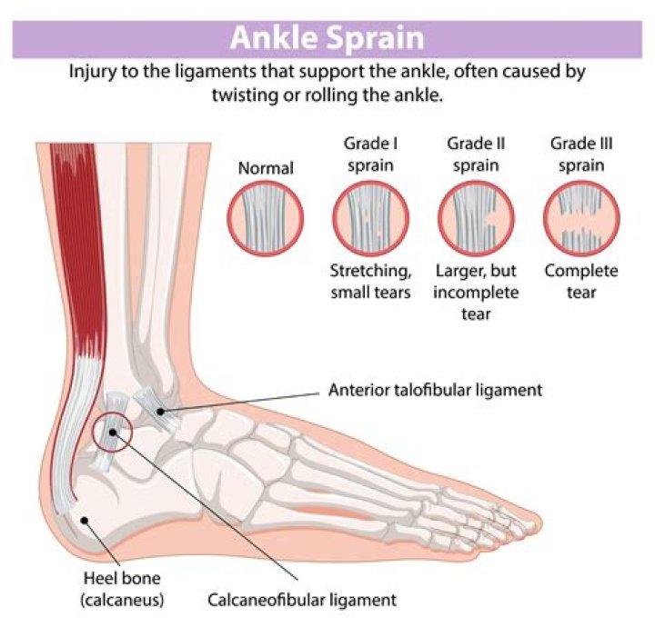 Can a sprained foot get worse?