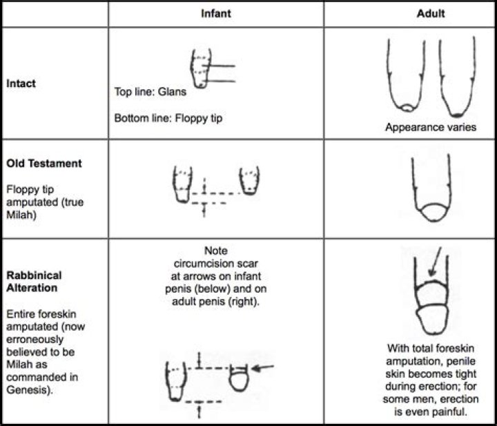 Can circumcision be done twice?