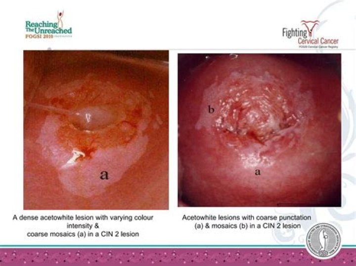 Can HPV come back after colposcopy?