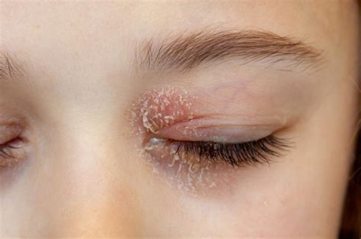 Can salt cure eczema?