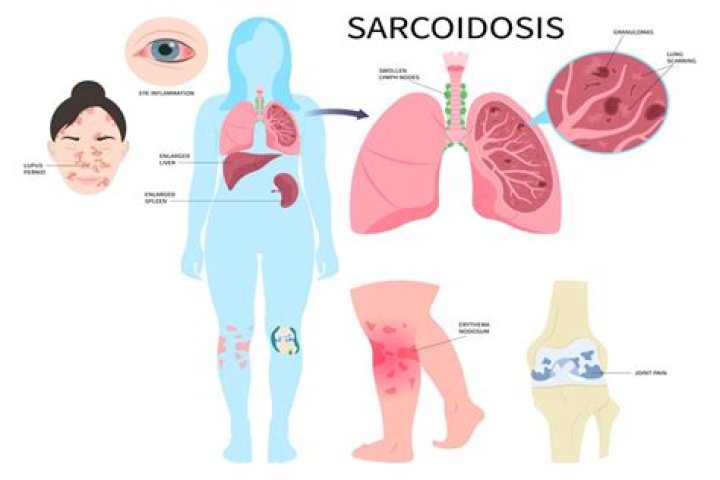 Can sarcoidosis affect your legs?
