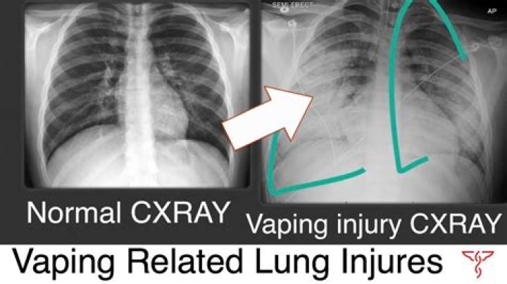 Can vaping show up on xray?