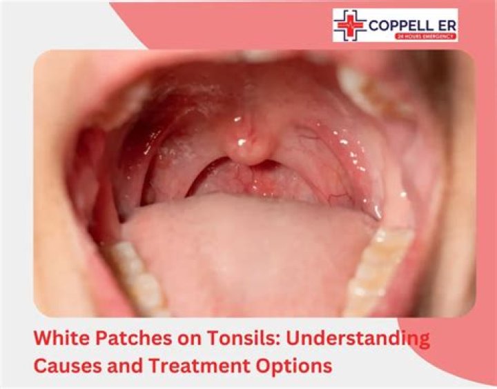 Can viruses cause white patches in throat?