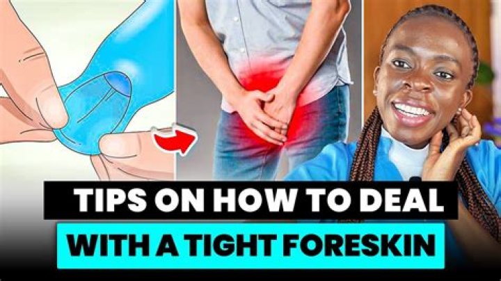 Can you get your foreskin removed at 18?