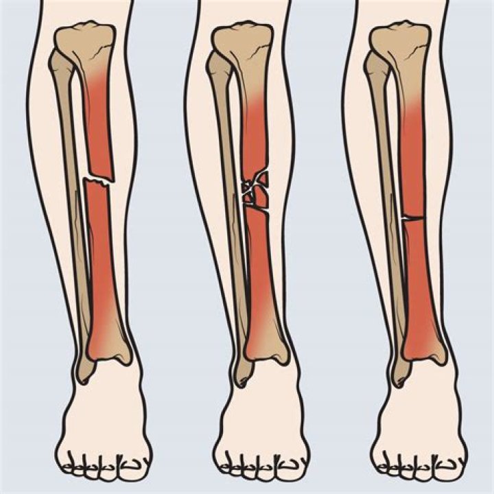 Can you walk with tibia fracture?
