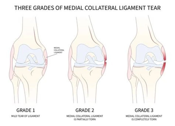 Do grade 3 ligament tears need surgery?