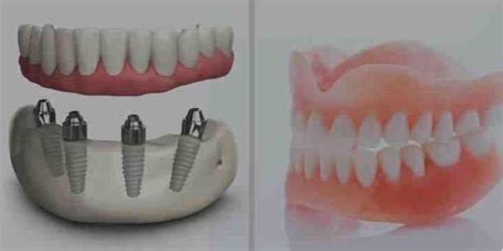Do permanent dentures fit better than temporary dentures?