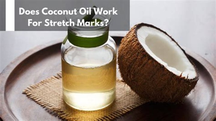 Does coconut oil prevent stretch marks?