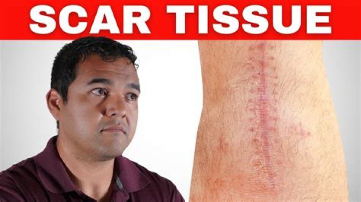 Does Crohn's cause scar tissue?