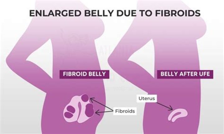 Does fibroid affect ovulation?