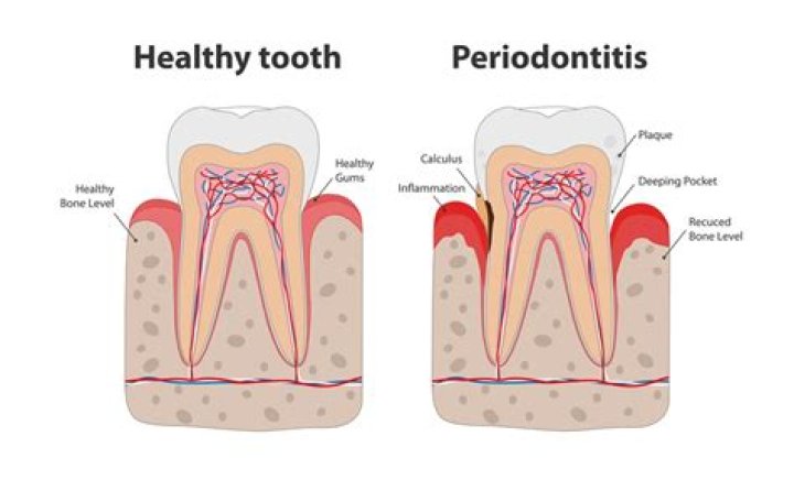 Does periodontitis hurt?
