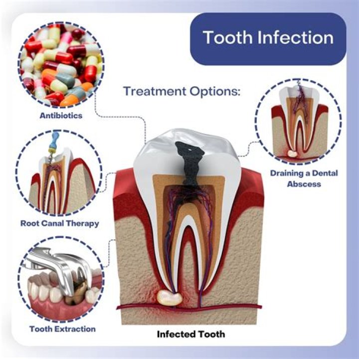 Does salt draw out infection in tooth?