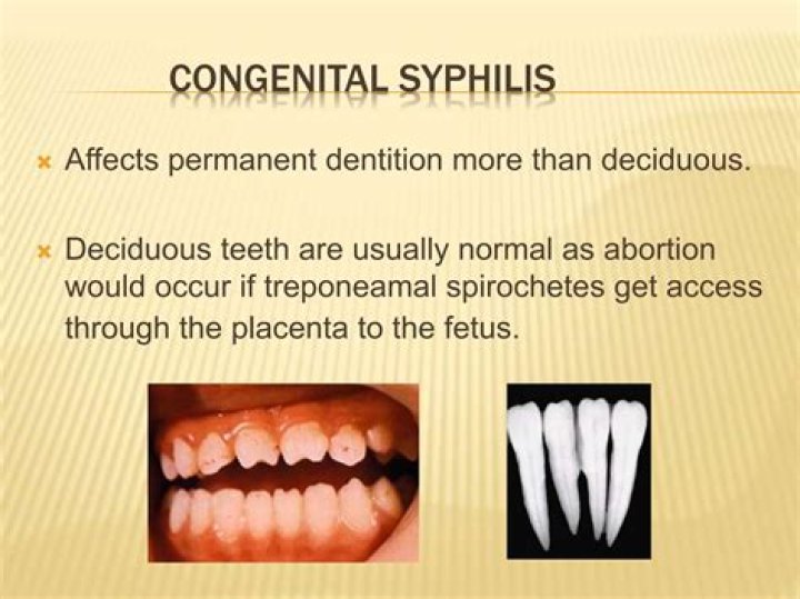 Does syphilis affect sperm?