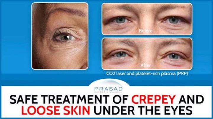 Does walking help Crepey skin?