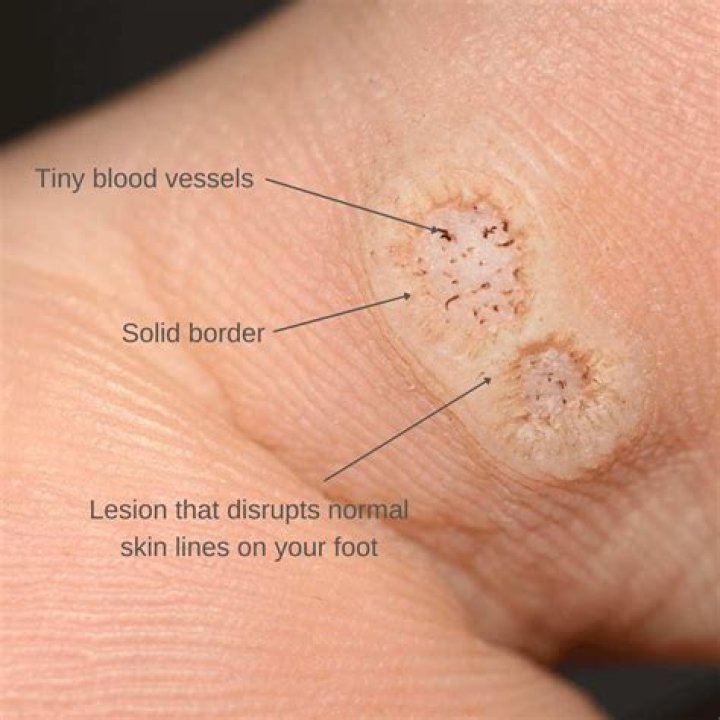 How deep can a wart grow?