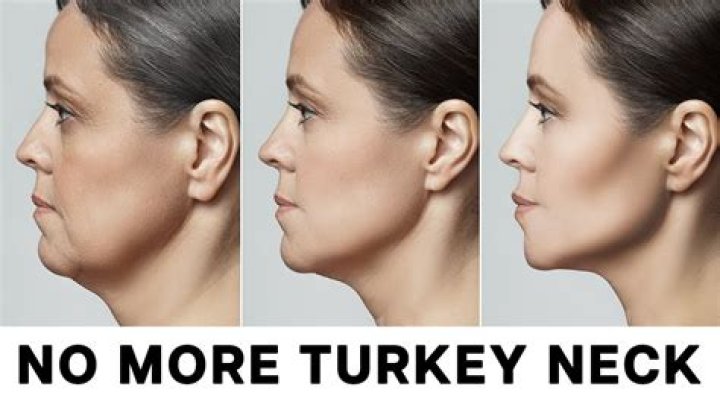 How do you get rid of turkey neck?