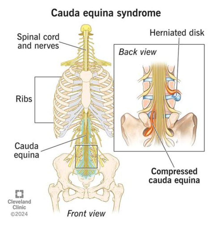 How do you rule out cauda equina syndrome?