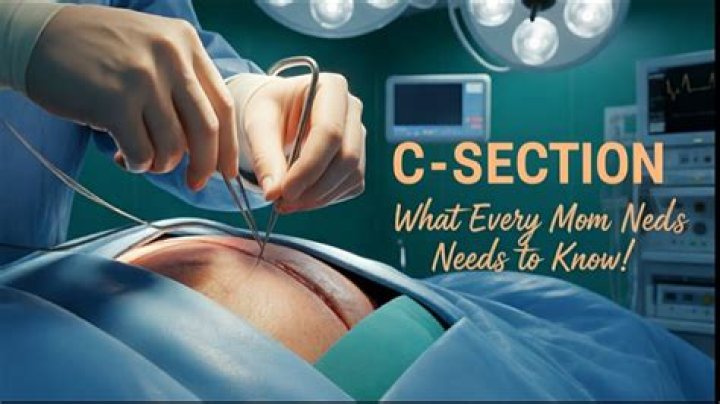 How many C-sections can I have?