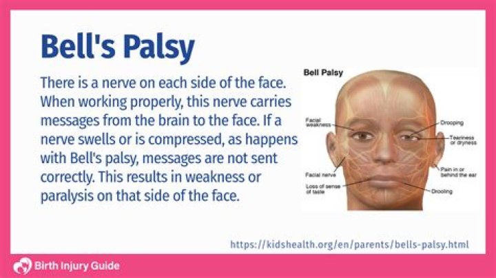 How quickly does Bell's palsy start?