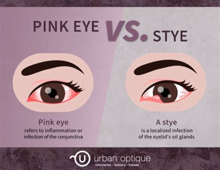 Is pink eye a big deal?