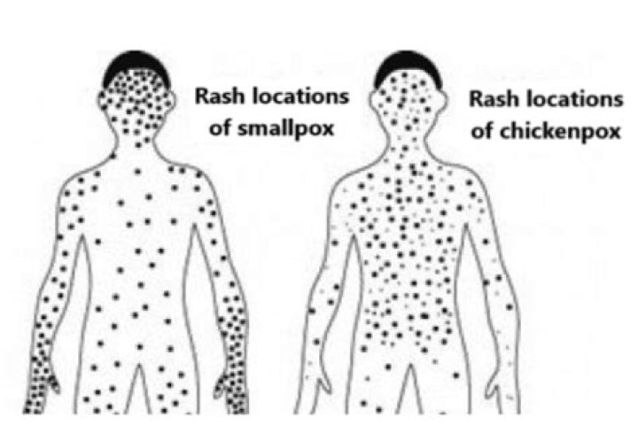 Is smallpox and chickenpox the same thing?