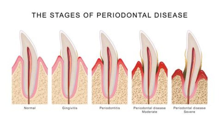 Should I be worried if I have periodontitis?