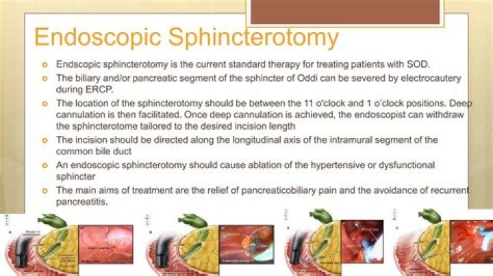 What are the risks of sphincterotomy?