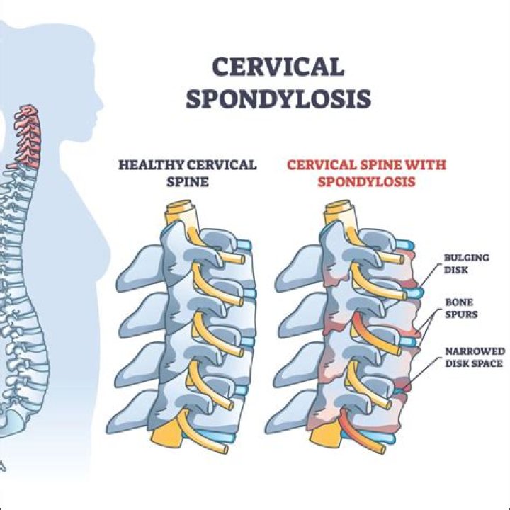What causes cervical dysplasia besides HPV?