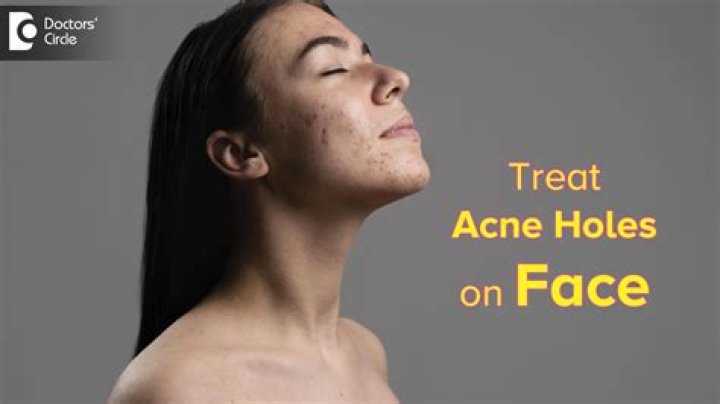 What causes holes in your face?