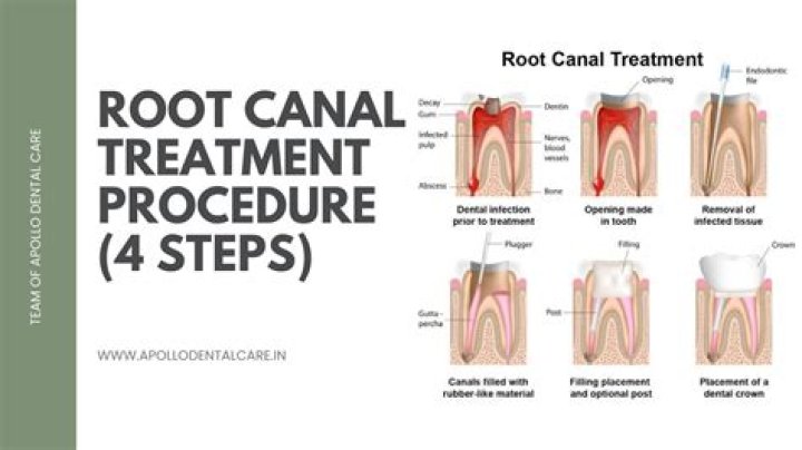 What happens on second root canal visit?