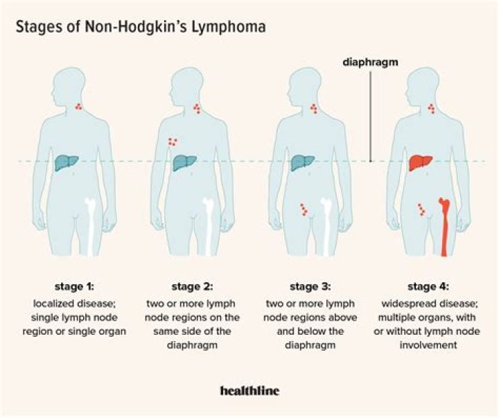 What is Stage 1 Non Hodgkins?