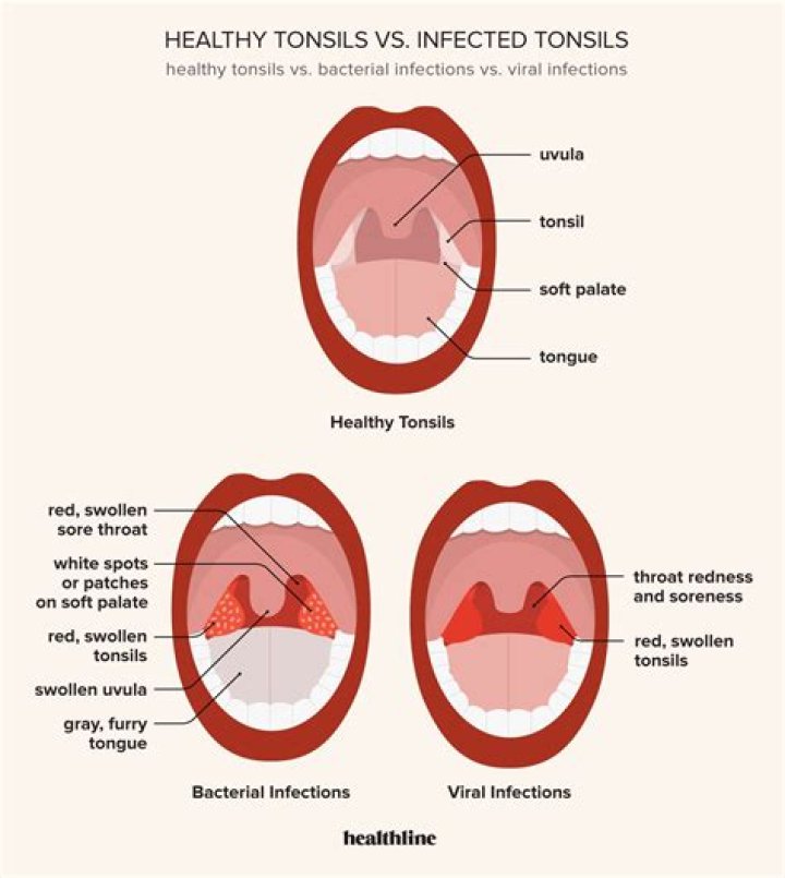 What is symptoms of tonsil infection?