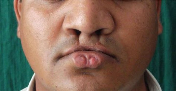What is van der Woude syndrome?