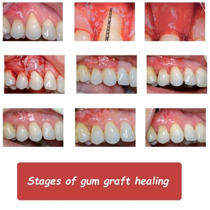 When can I look at my gum graft?