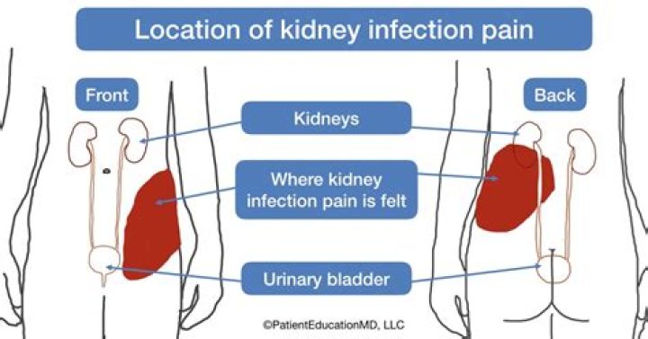 Where does it hurt when you have a kidney infection?