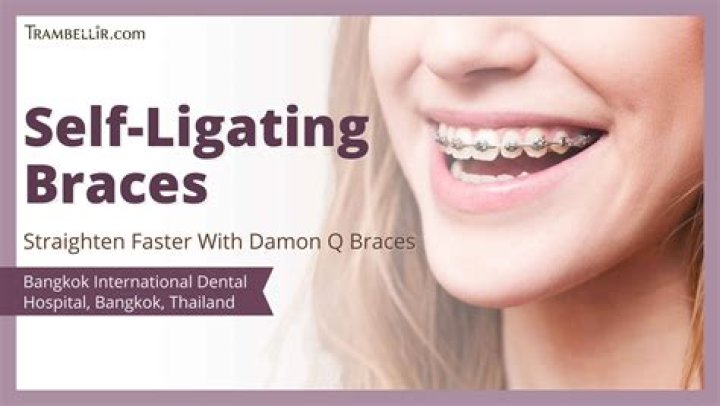 Which braces straighten teeth faster?