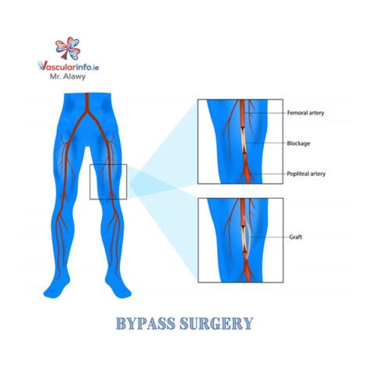 Which is better bypass or stent?