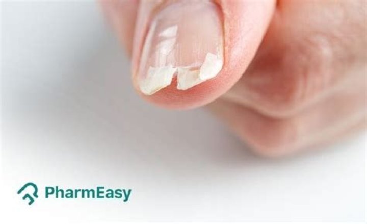 Why are my nails splitting lengthwise?