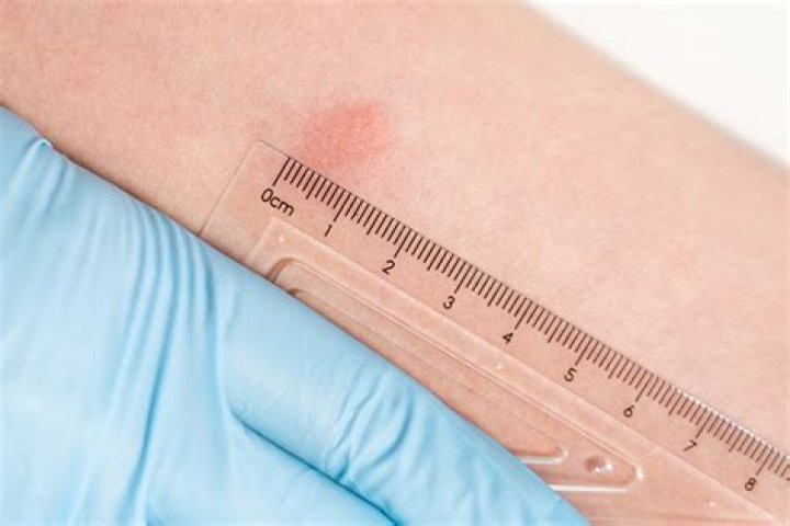 Why is my TB test itchy?