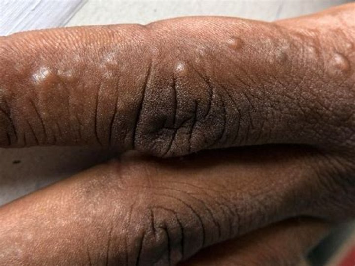 Why won't my eczema go away?
